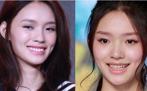 明星做嘴巴,揭秘他们迷人嘴巴的秘密